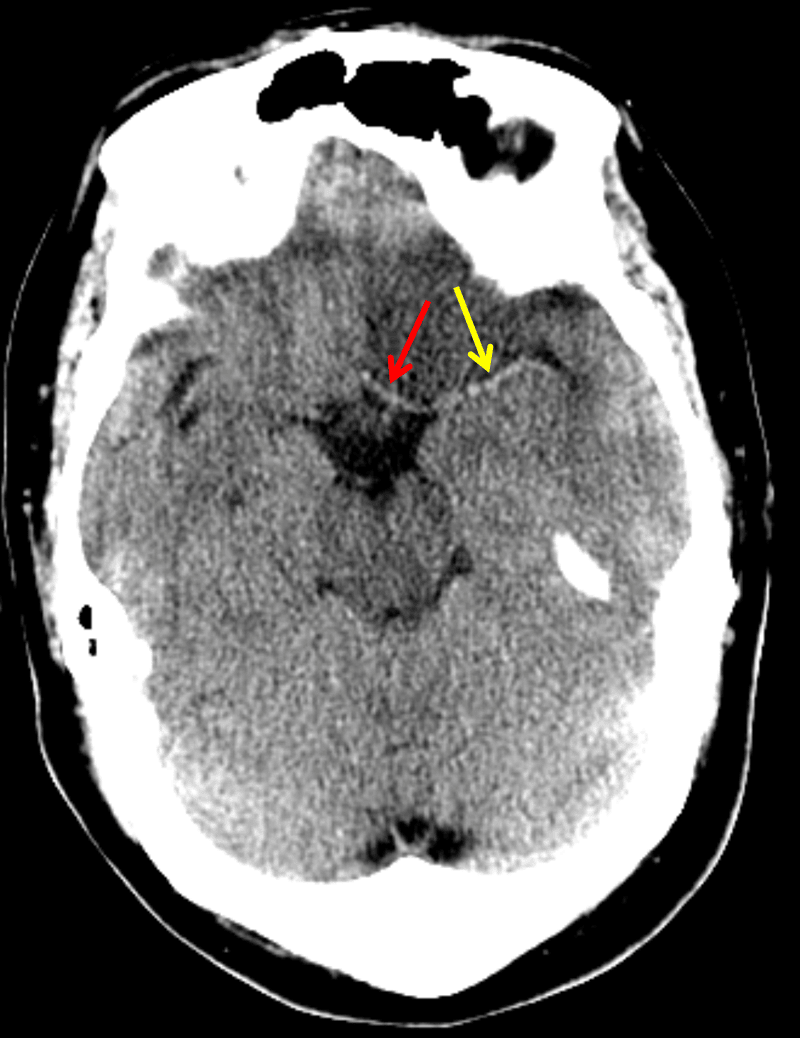 Asymmetrically hyperattenuating appearance of the proximal left ACA (red arrow) and MCA (yellow arrow) concerning for thrombosis