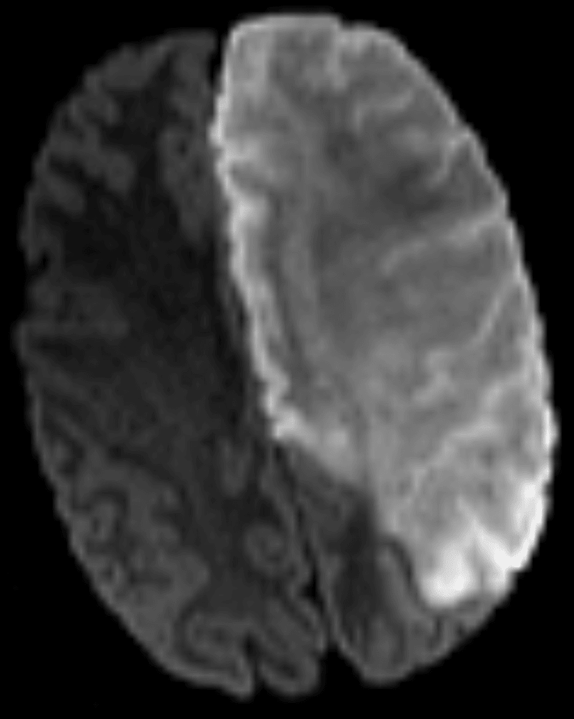 Representative diffusion-weighted MR image from this patient