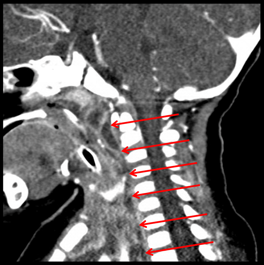 Red arrows: extension of infection through the retropharyngeal space.