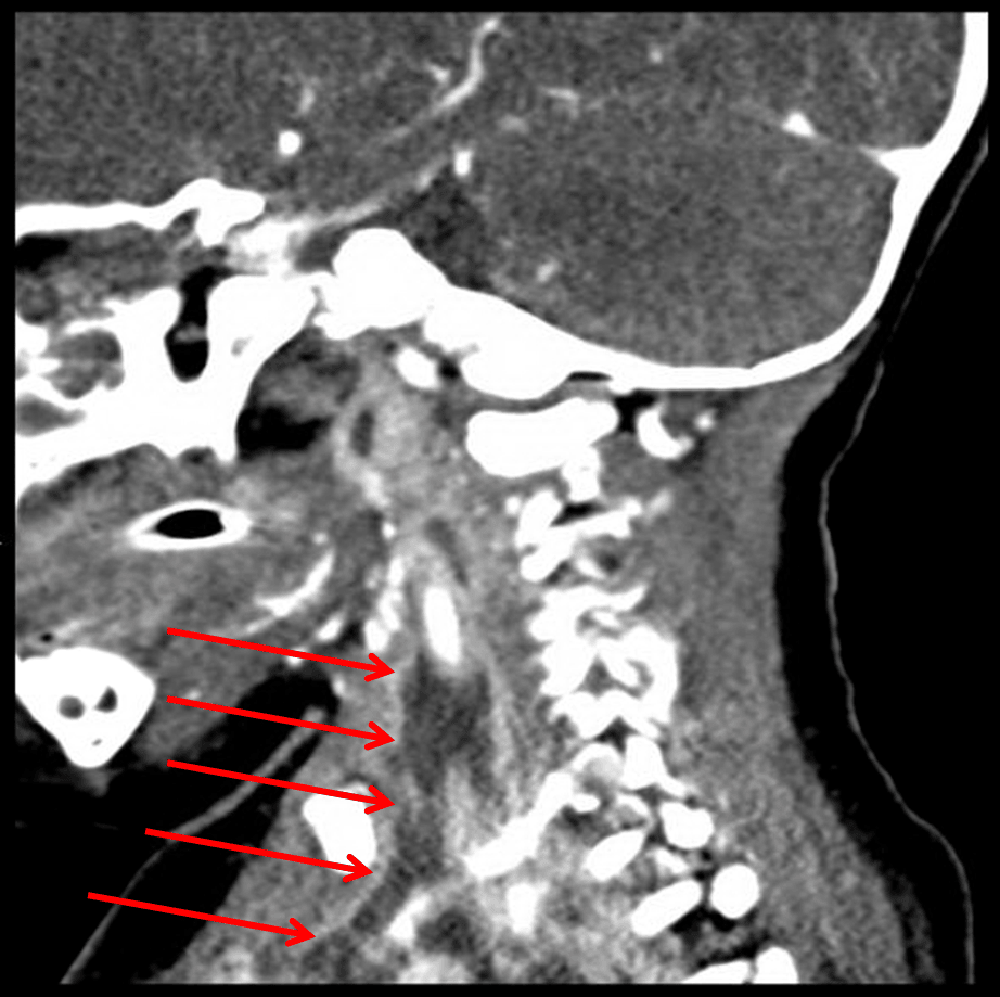 Red arrows: extension of infection through the carotid space.