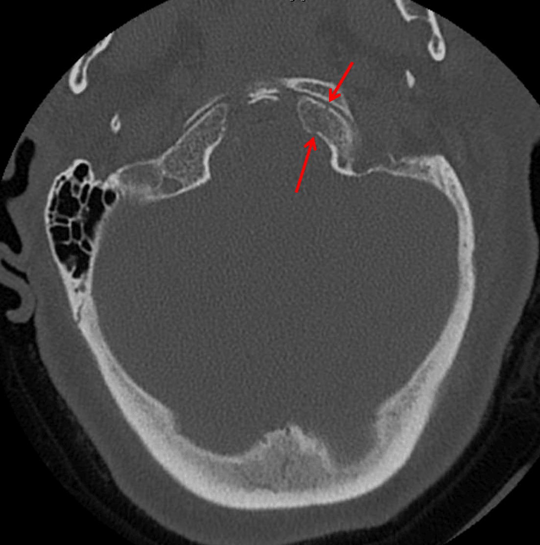 Red arrows: nondisplaced left occipital condyle fracture.