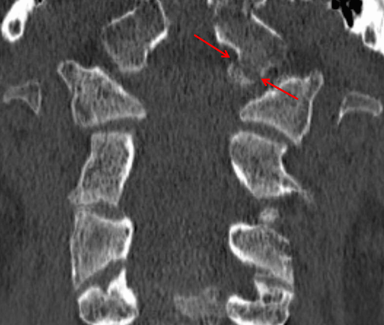 Red arrows: displaced left occipital condyle fracture.
