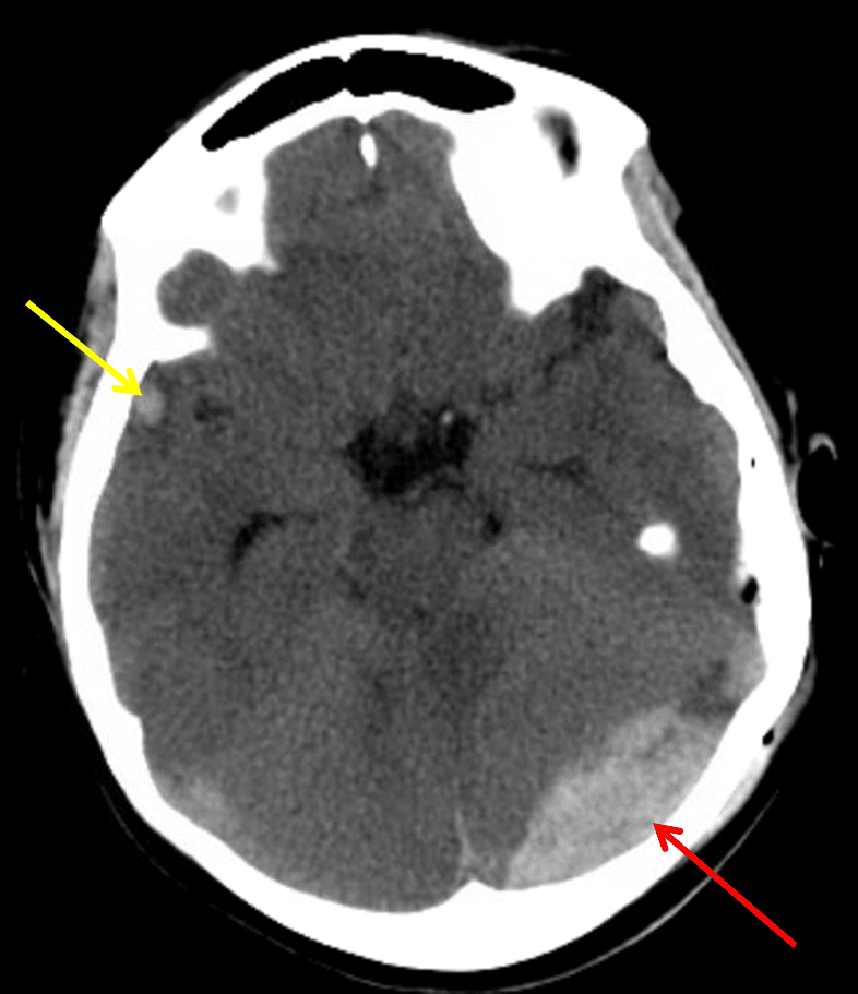 Red arrow: acute epidural hematoma. Yellow arrow: small contrecoup cerebral contusion.