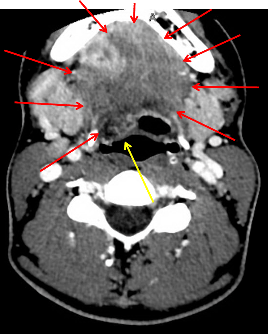 Fluid extending along the right floor of the mouth (red arrows). Mass effect on the pharynx (yellow arrow).