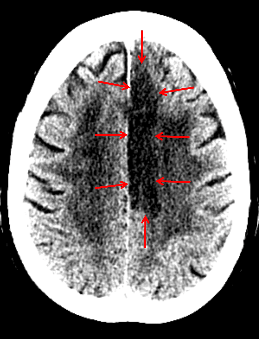Red arrows: ACA territory infarct