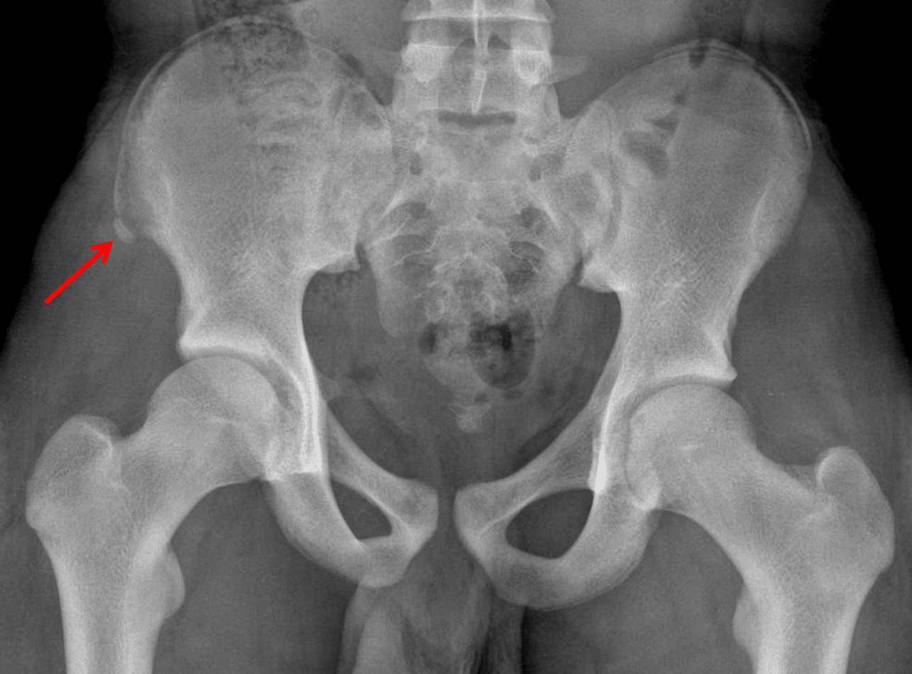 Red arrow: ASIS avulsion fracture in this patient.