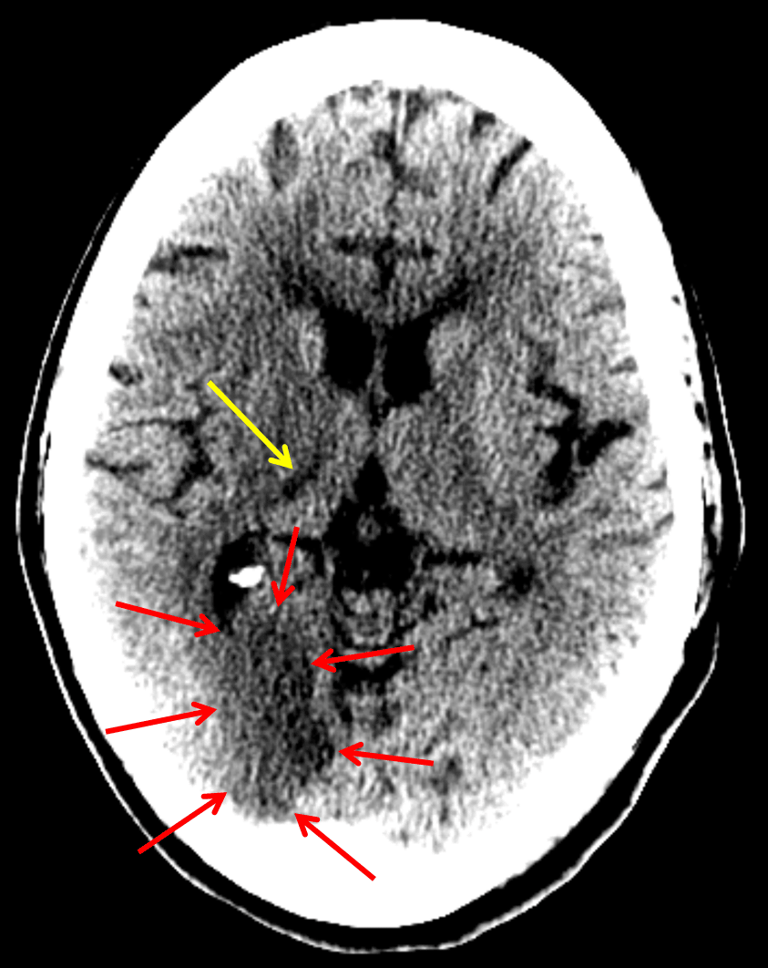 Red arrows: acute/early subacute infarct in the right occipital lobe. Yellow arrow: age-indeterminate right thalamic infarct (looked acute on the subsequent MRI)