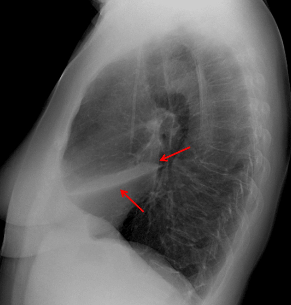 Red arrows: anterior airspace opacity sharply marginated by the major fissure inferiorly.