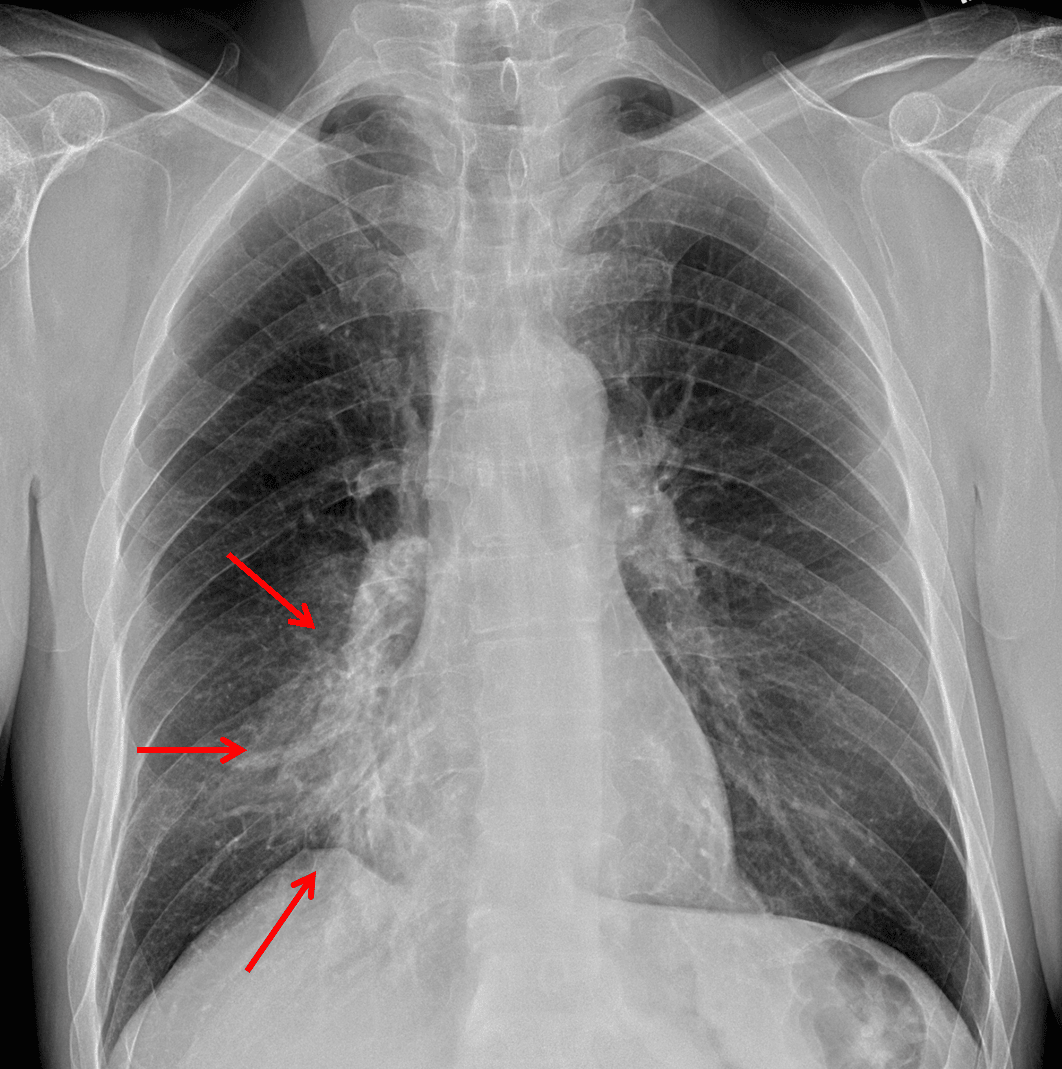 Red arrows: hazy airspace opacity with obscuring of the right heart border.
