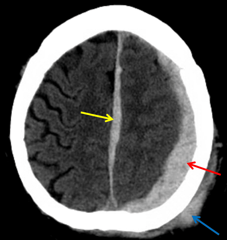 Red arrow: acute subdural hematoma layering along the left cerebral convexity. Yellow arrow: subdural hematoma layering along the interhemispheric falx. Blue arrow: scalp hematoma.