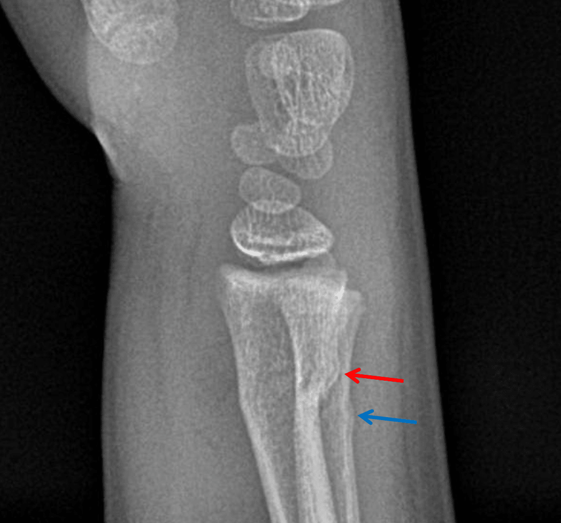 Acute buckle fractures of the dorsal distal radial (red arrow) and ulnar (blue arrow) metaphyses.