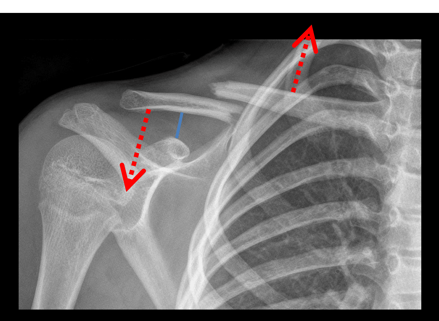 Red arrows: upward pull on the medial fracture fragment by the SCM and downward pull on the lateral fragment by the weight of the arm. Blue line: normal coracoclavicular distance