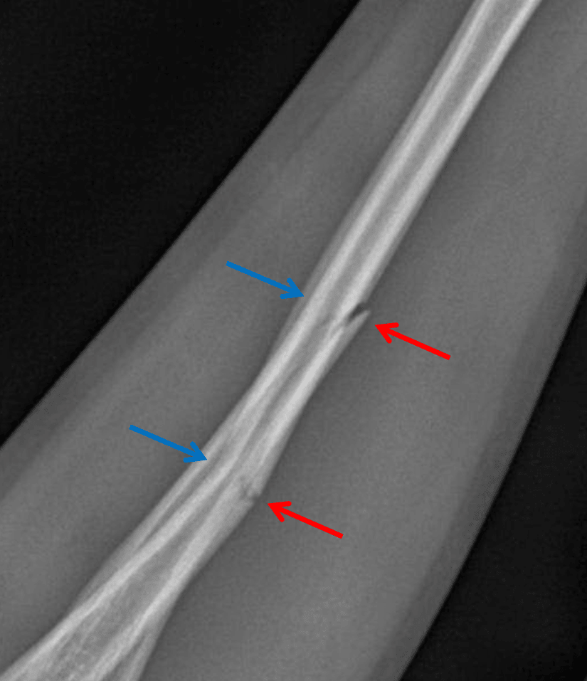 Greenstick Fracture - Red arrows: disrupted cortex. Blue arrows: intact opposite cortex.