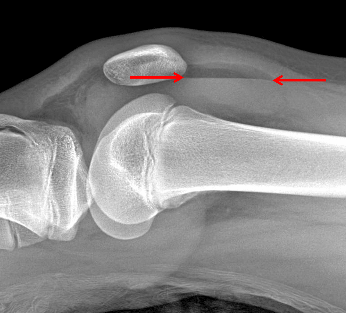 Red arrows: fat fluid level indicating a lipohemarthrosis.