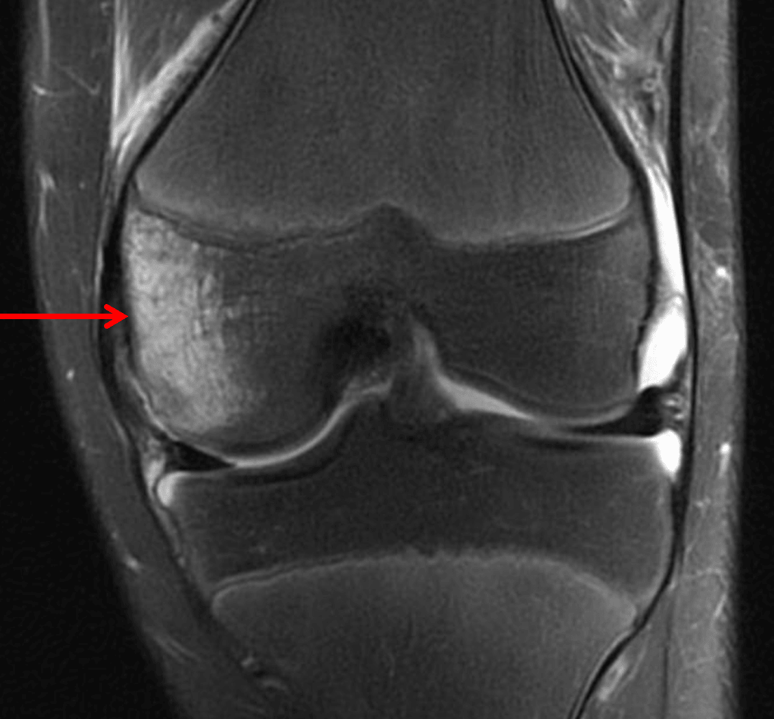 Followup knee MRI in this patient shows a large medial femoral condyle bone contusion without clear fracture line.