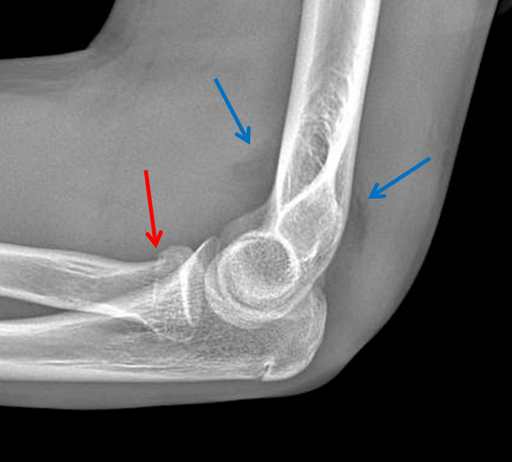 Red arrow: mildly impacted radial head fracture. Blue arrows: uplifted anterior and posterior fat pads indicative of a joint effusion.