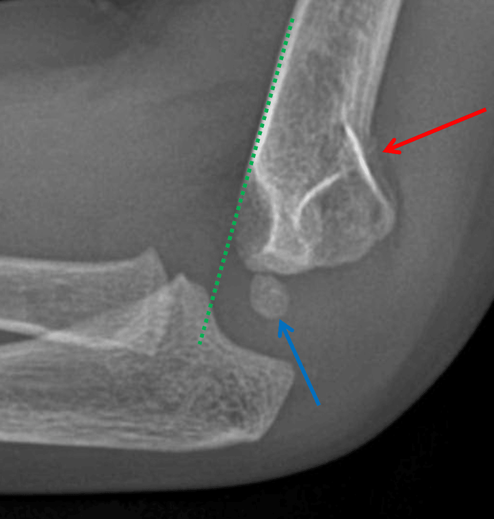 Anterior offset of the anterior humeral line (green dotted line) relative to the capitellum (blue arrow). Acute supracondylar fracture with mild posterior angulation (red arrow).