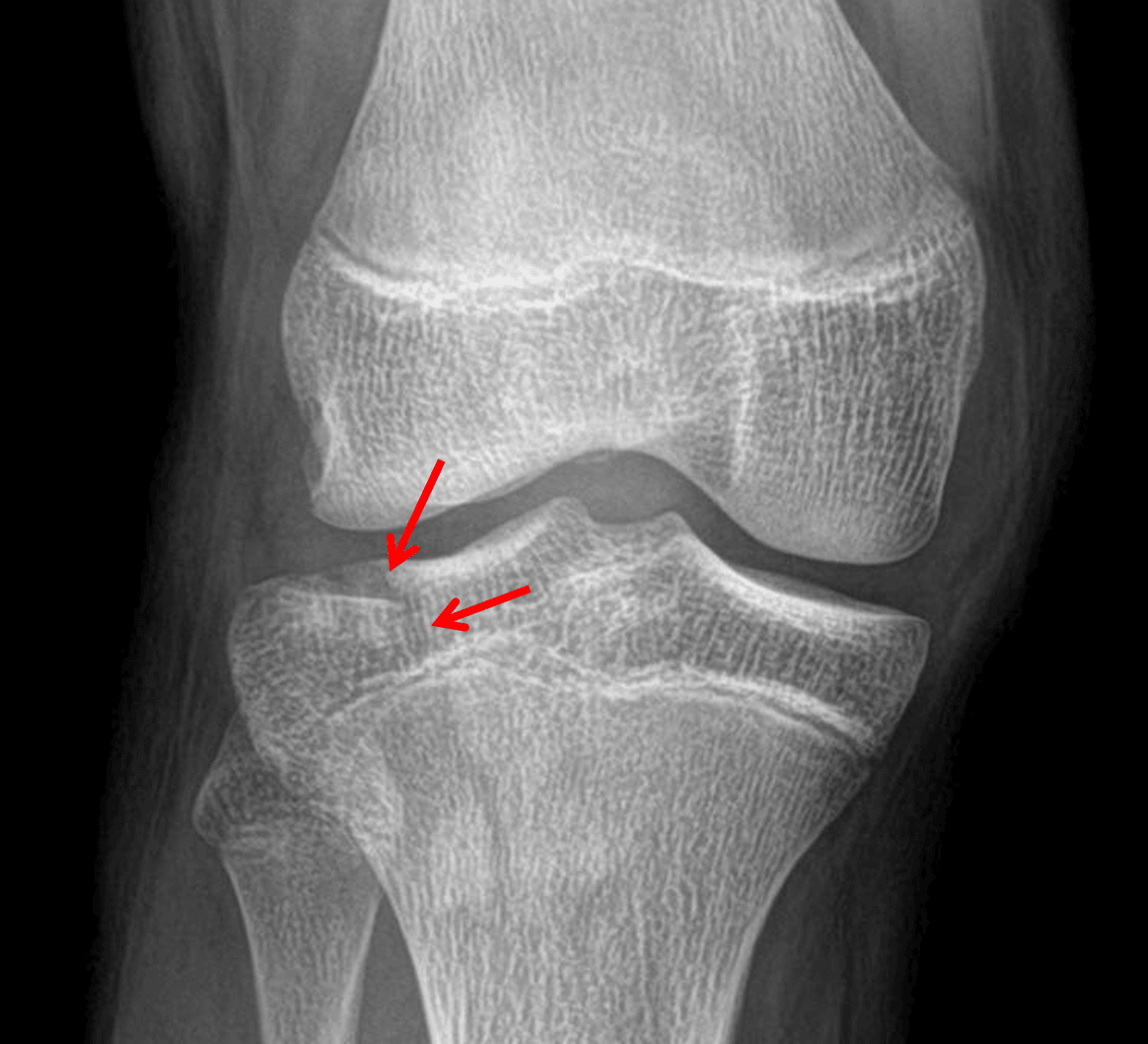 Red arrows: minimally depressed Saltar IV fracture of the lateral tibial plateau (Schatzker I).