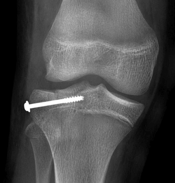 Postoperative radiograph in this patient.