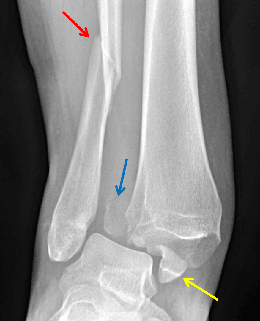 Weber type C fracture - Angulated distal fibular fracture (red arrow) with associated tibiofibular syndesmotic injury and displaced posterior (blue arrow) and medial (yellow arrow) malleolar fractures.