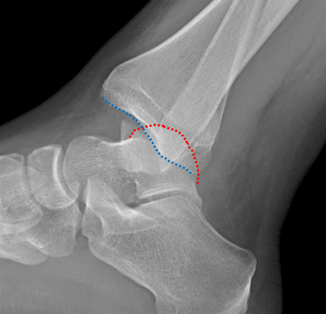 Posterior dislocation of the ankle with the talar dome (red dotted line) positioned posterior to the tibial plafond (blue dotted line).