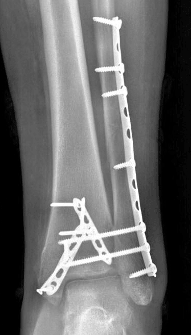 Radiograph in this patient after ORIF.