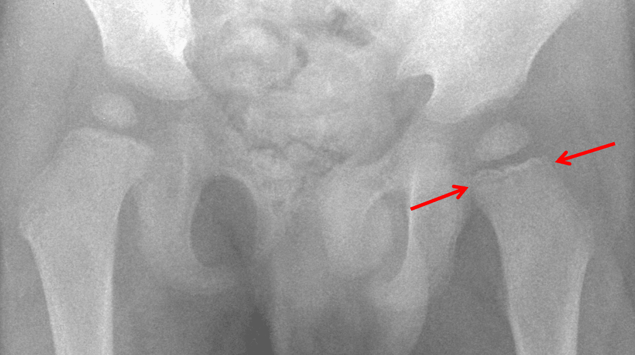 Red arrows: subtle lucent metaphyseal band.