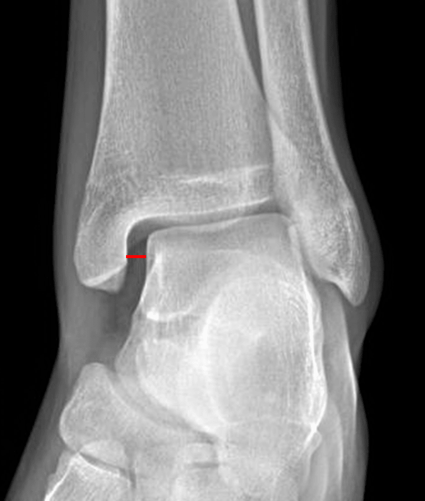 Red line: medial clear space widening concerning for ligamentous injury.