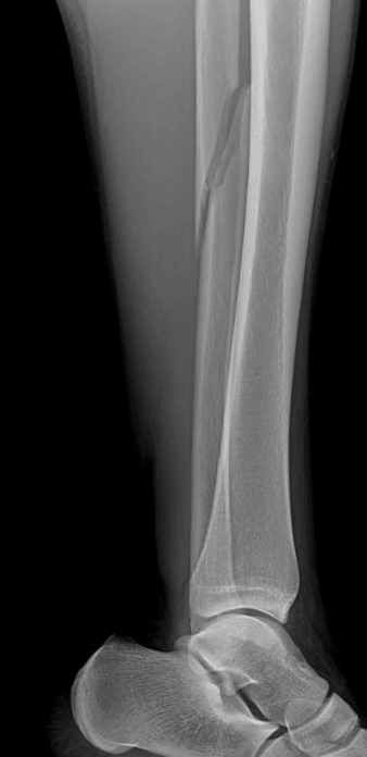 Tibia/fibula radiograph in this patient shows a proximal fibular fracture consistent with a Maisonneuve fracture