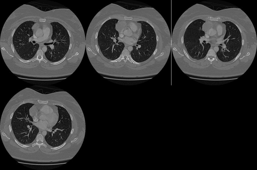 Subsequent CT shows an anterior mediastinal mass most consistent with a thymoma.