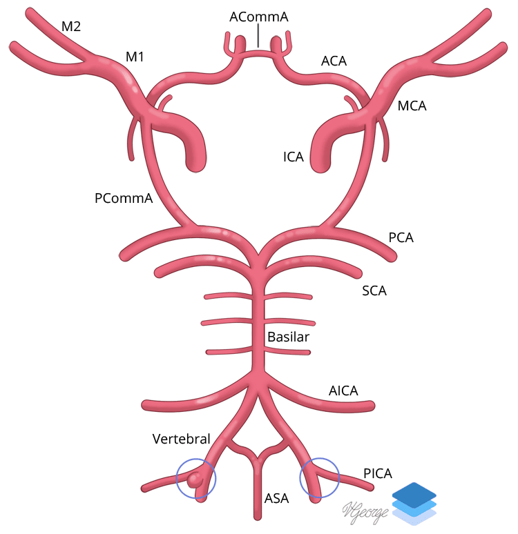 Aneurysm of PICA
