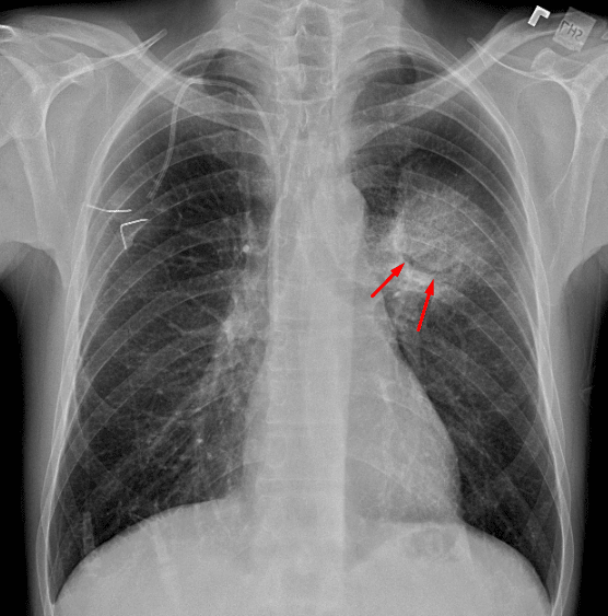 Rounded opacity centered in the superior aspect of the left lower lobe with an air crescent (red arrows).