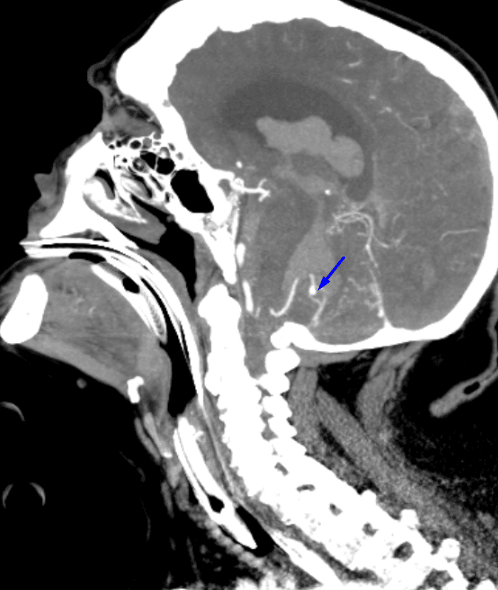 Blue arrow: left PICA aneurysm.
