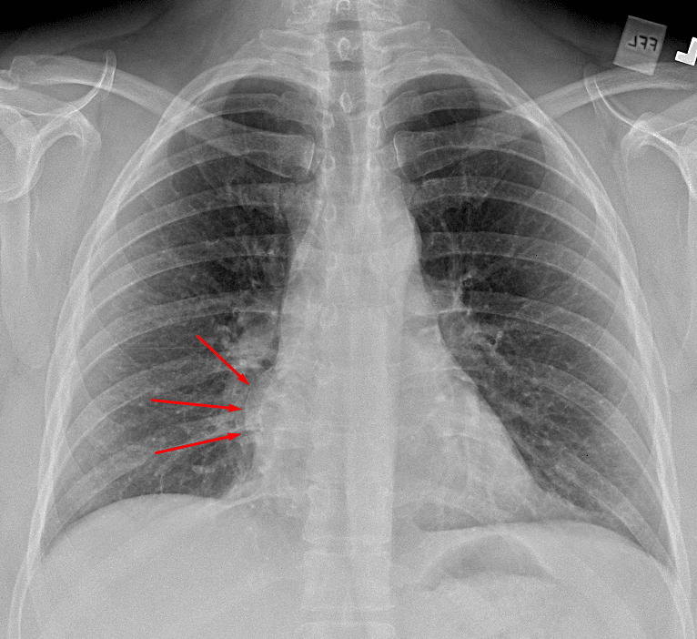 Approximately 4 cm mass in the mediastinum (red arrows) adjacent to the right heart border.