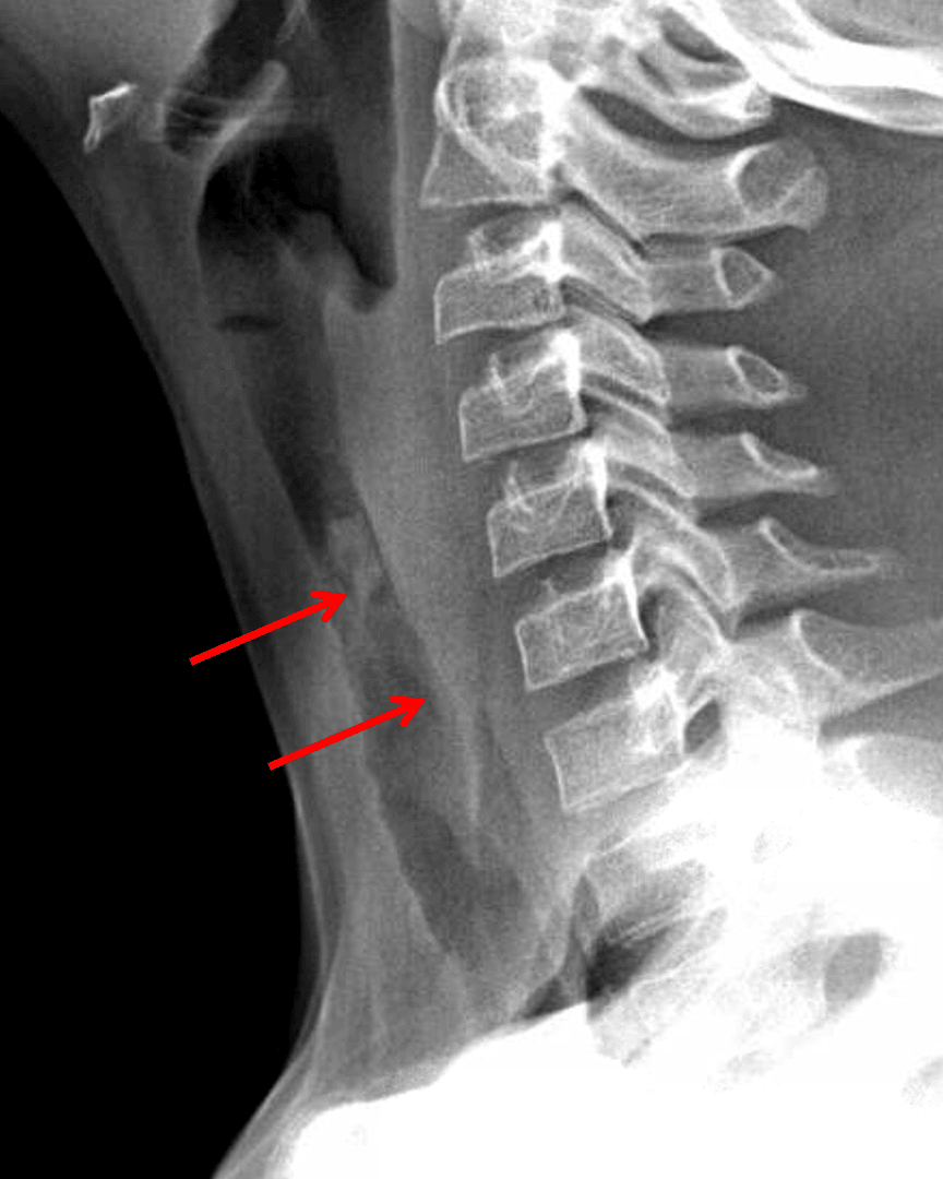 Traqueitis Rx Radiology Case #18 | CaseStacks