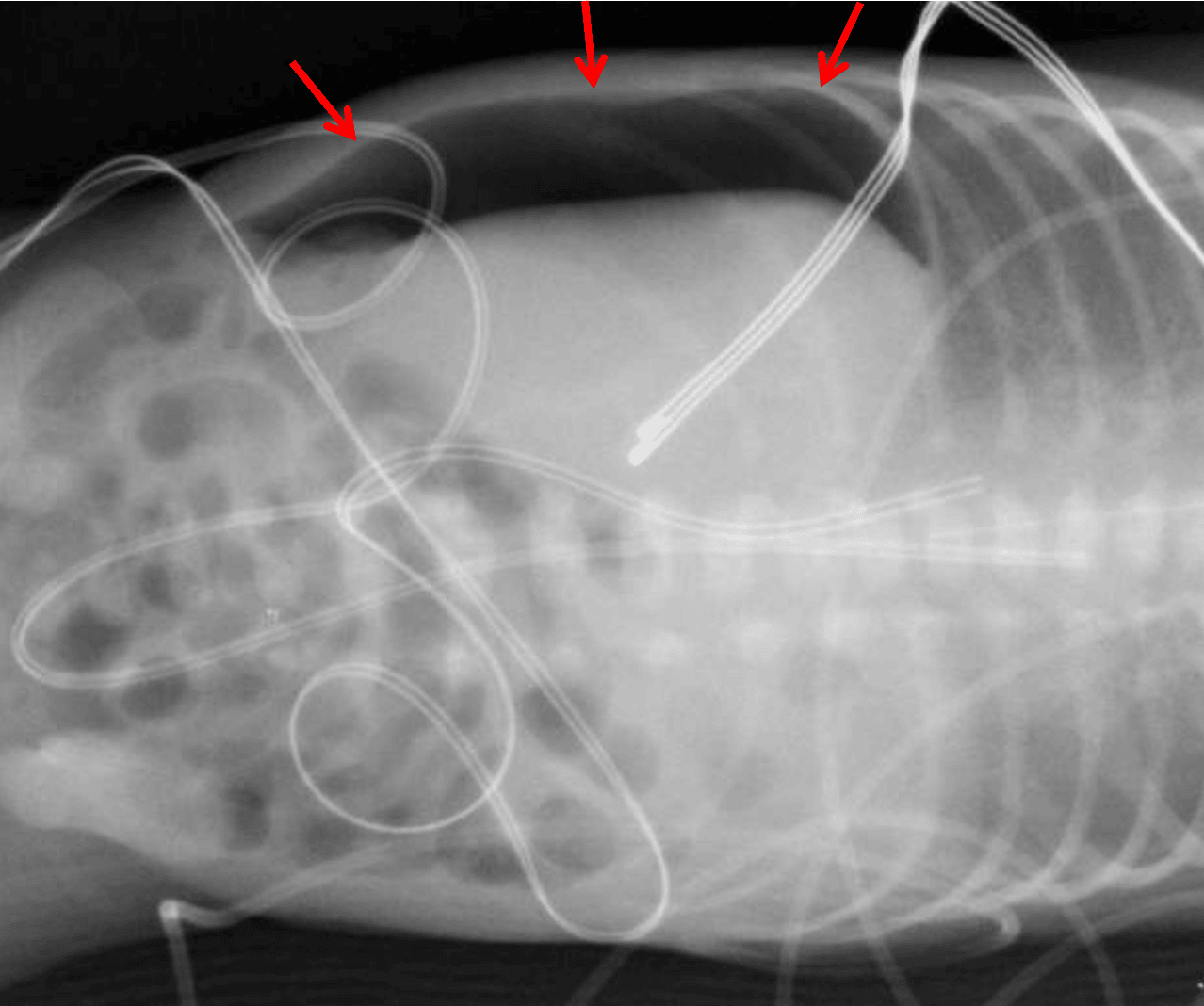 Red arrows: large volume pneumoperitoneum on left side down lateral decubitus view.