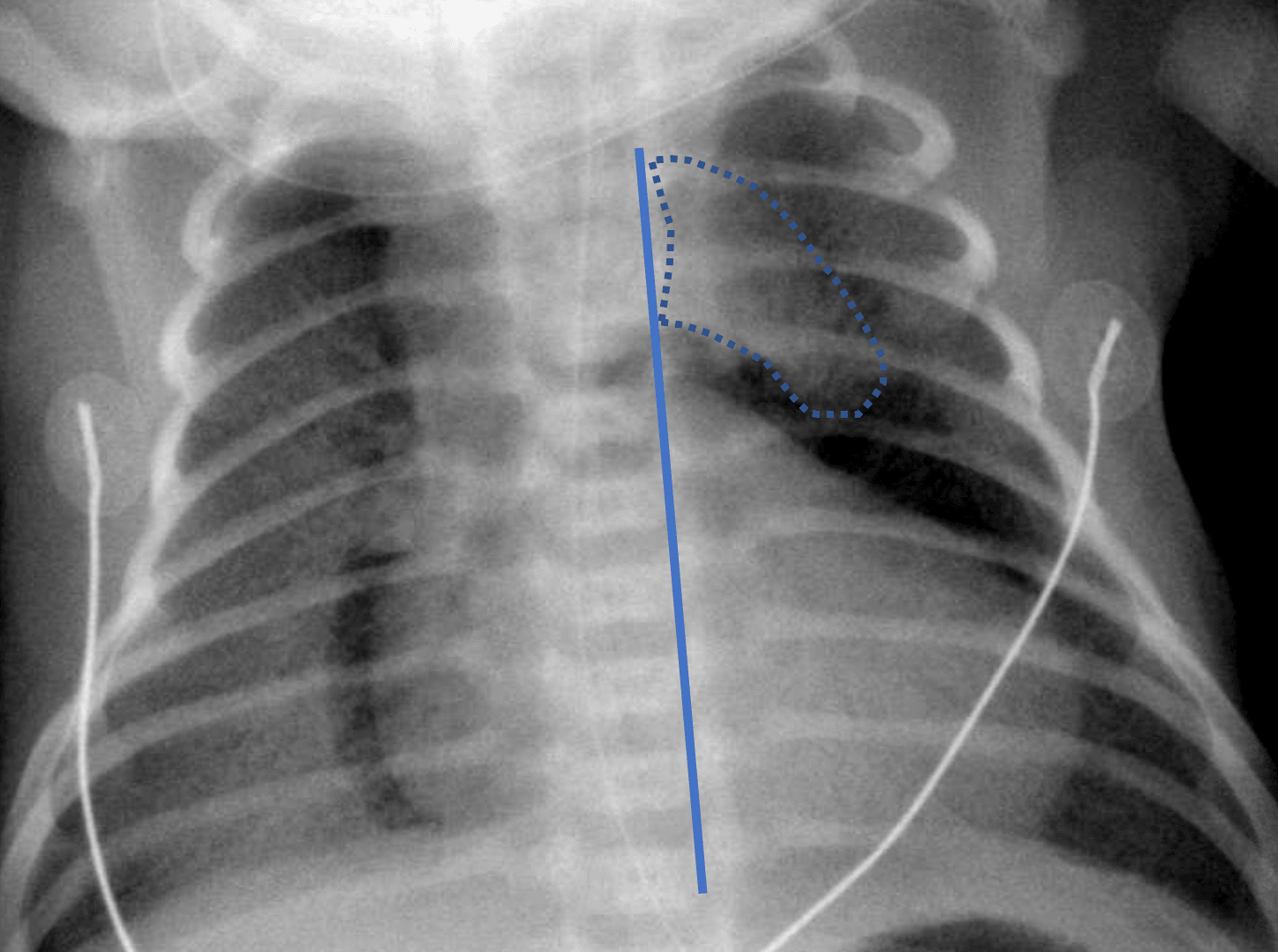 Spinacker Sign Radiology Case #33 | CaseStacks