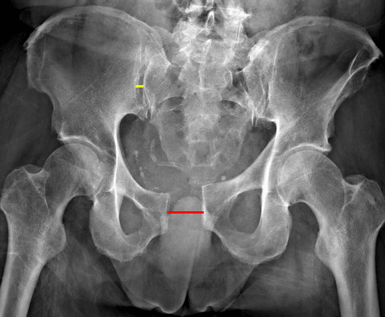 APC II unstable pelvic ring injury with widening of the pubic symphysis (red line) and anterior right sacroiliac joint (yellow line).