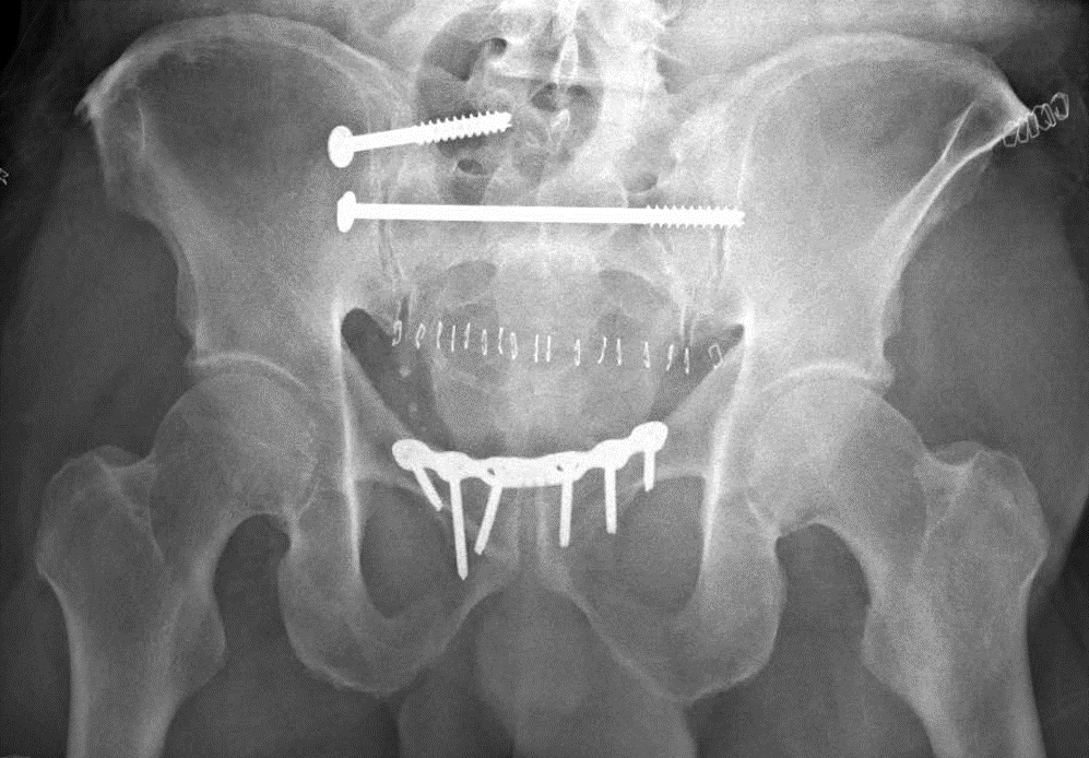 Postoperative radiograph in this patient.