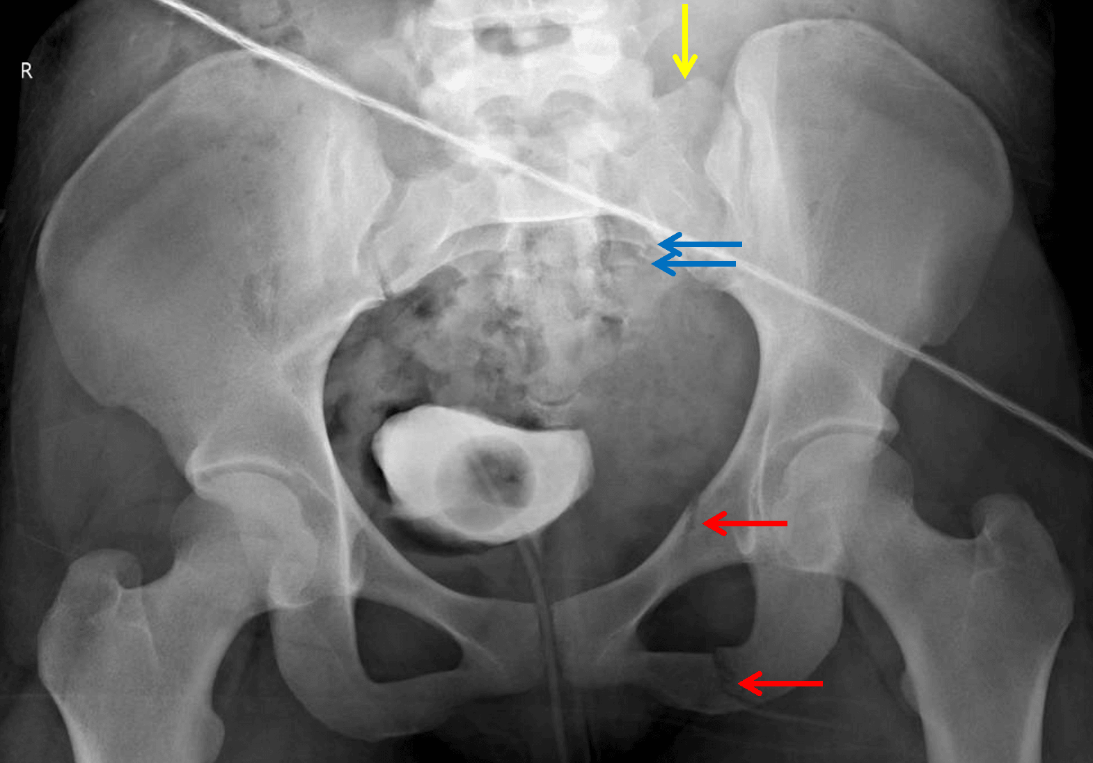Stable pelvic ring injury (LC I) with left obturator ring fractures (red arrows) and left sacral fracture with slight offset of the left sacral ala (yellow arrow) and several arcuate lines (blue arrows).