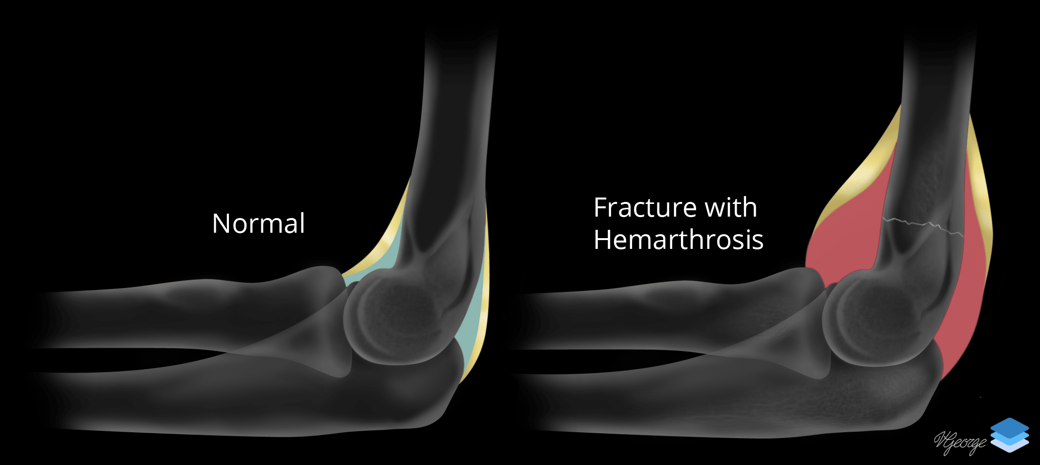 Elbow joint effusion. Illustration by Valerie George, MD