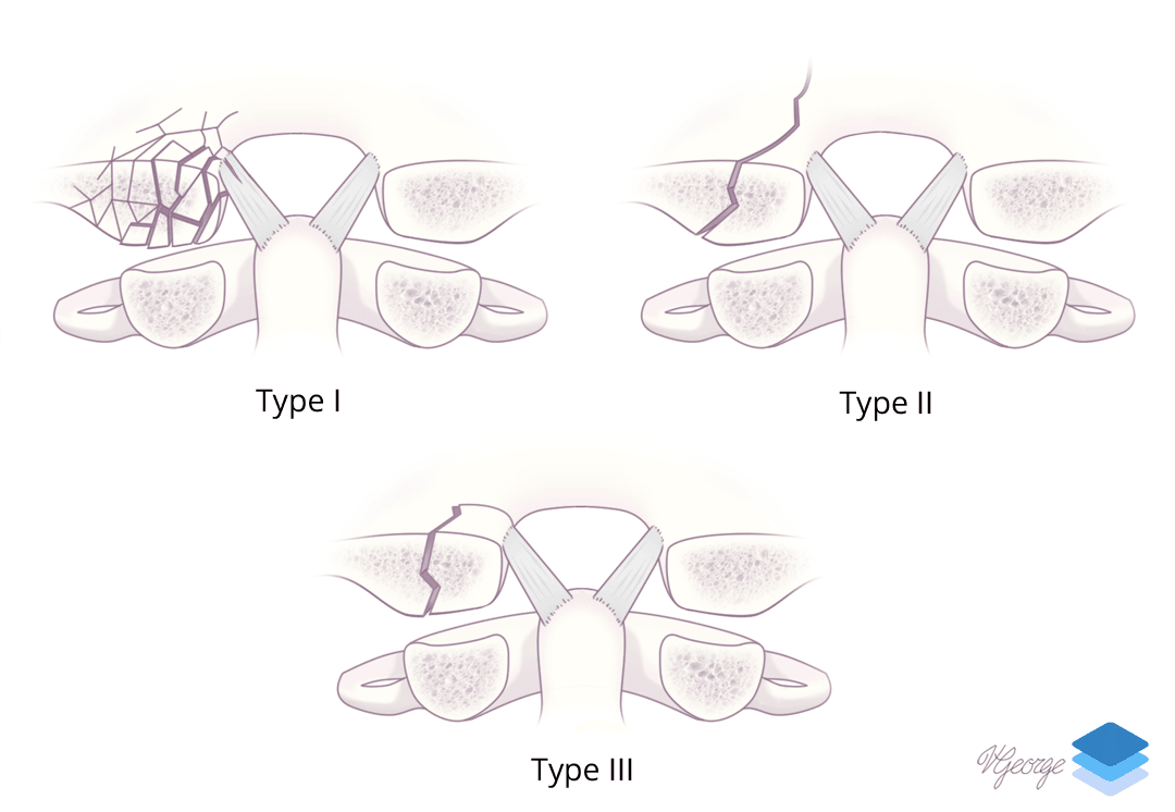 Occipital condyle fractures.