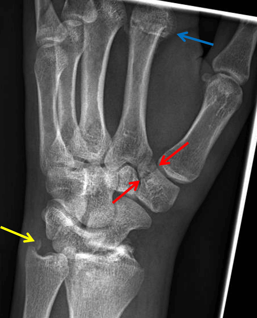 Red arrows: nondisplaced fracture of the trapezium. Yellow arrow: ulnar styloid fracture. Blue arrow: impacted second metacarpal neck fracture.