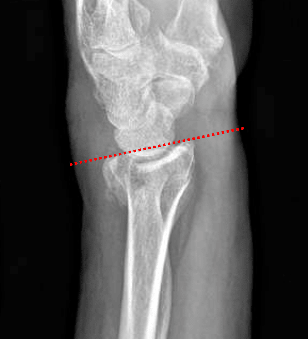 Colles fracture: lateral view shows mild dorsal tilt of the distal radial articular surface (red dotted line).