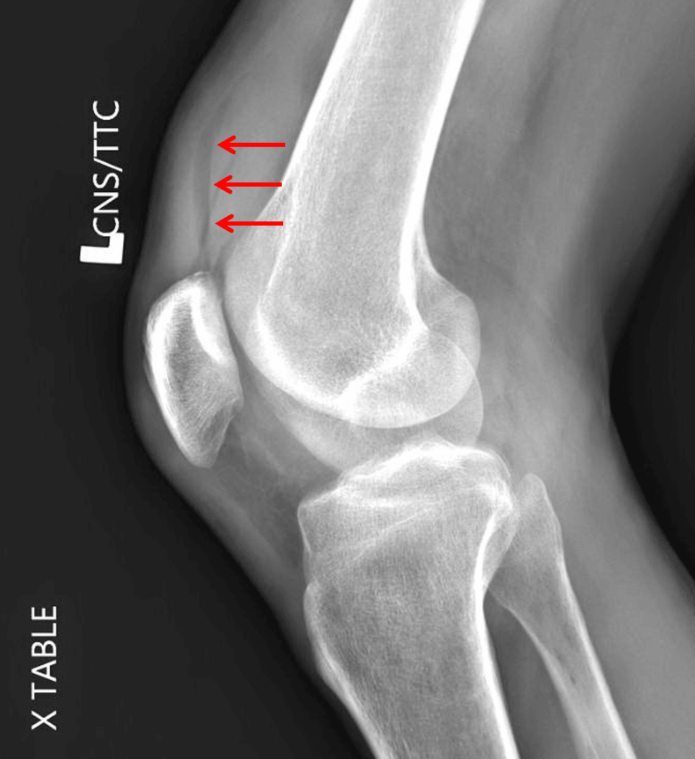 Lipohemarthrosis. Red arrows indicate the fat-fluid level.