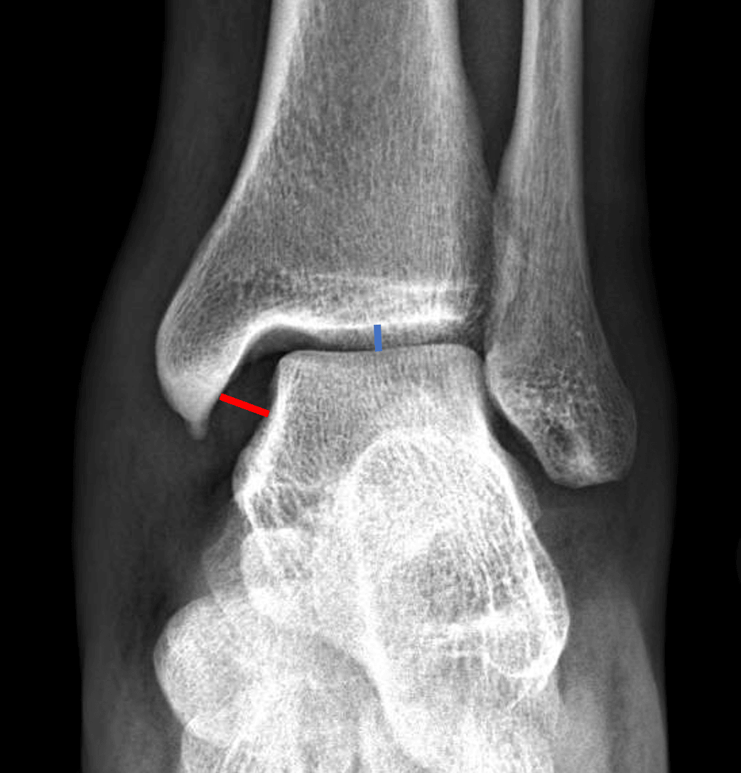 Medial clear space widening (red line compared to the normal blue line).