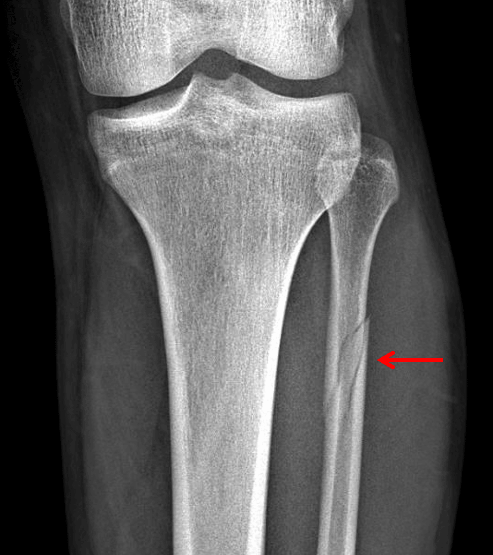 Subsequent tibia/fibula radiographs show a Maisonneuve fracture of the proximal fibula (red arrow).
