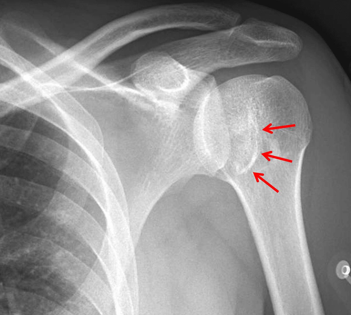 Red arrows: reverse Hill-Sachs fracture of the inferomedial humeral head resulting in a trough sign on frontal views.
