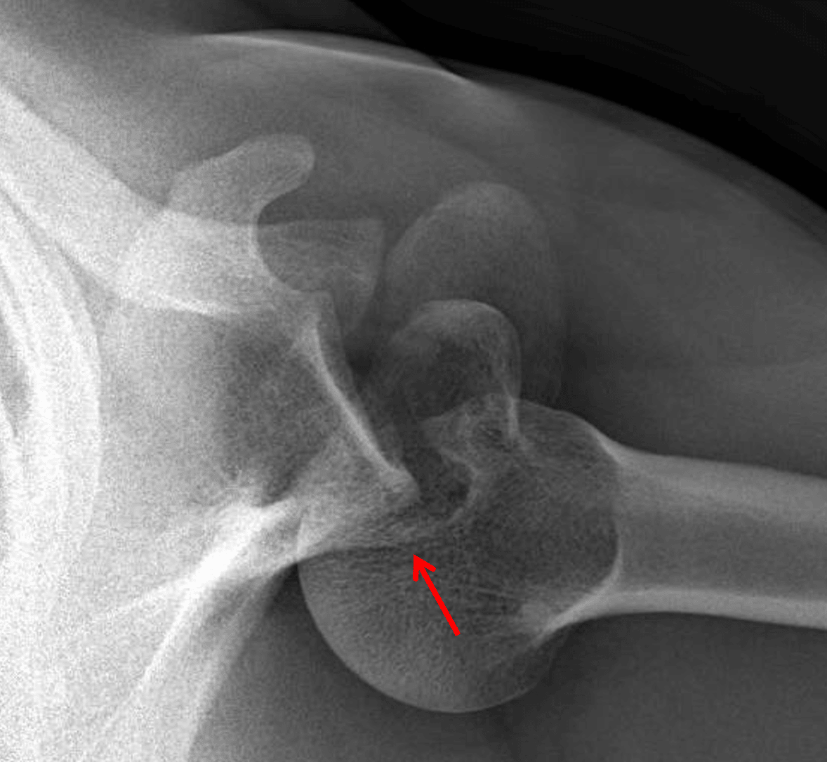 Red arrow: posterior shoulder dislocation with minimally displaced fracture of the posterior glenoid, best shown on this axillary view.