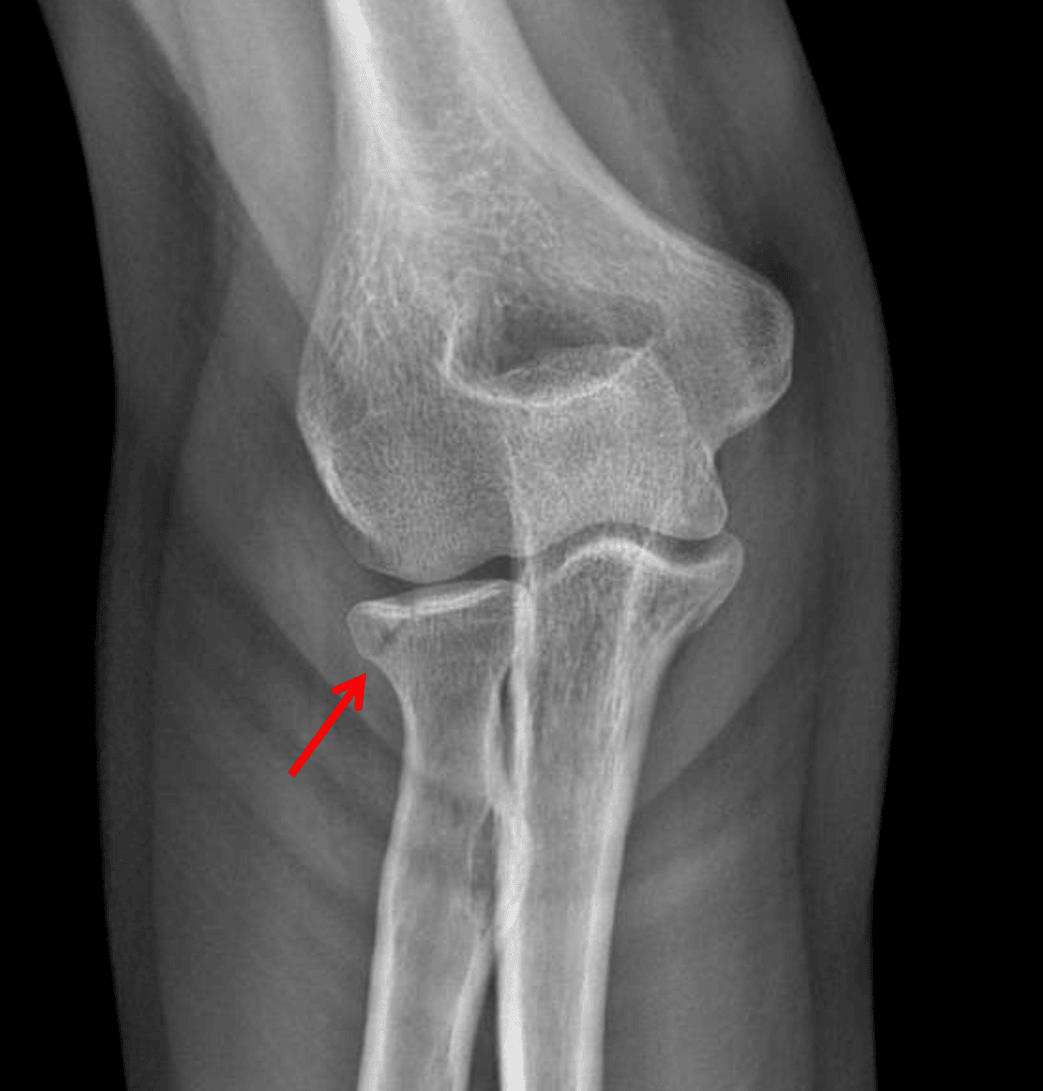 Red arrow: nondisplaced radial head fracture.